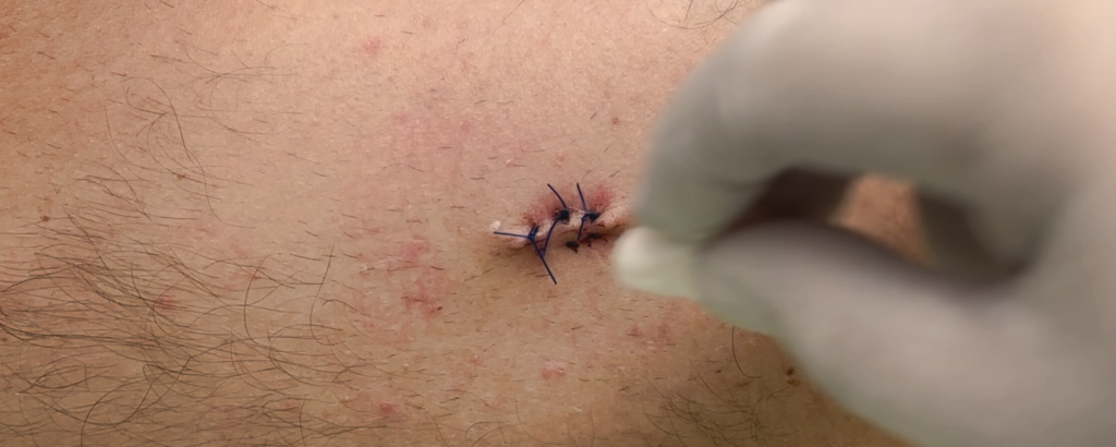 Αλλαγή και  περιποίηση τραύματος: καθαρισμός, αντισηψία, αλλαγή τραύματος και πότε χρειάζεται ιατρική βοήθεια.