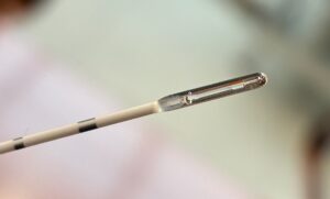 ανάρρωση μετά από laser θεραπεία κύστης κόκκυγος